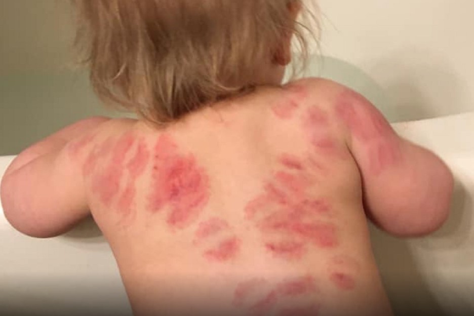 Illustratie bij: Heftige foto gaat het internet over: meisje wordt 25x gebeten op de opvang